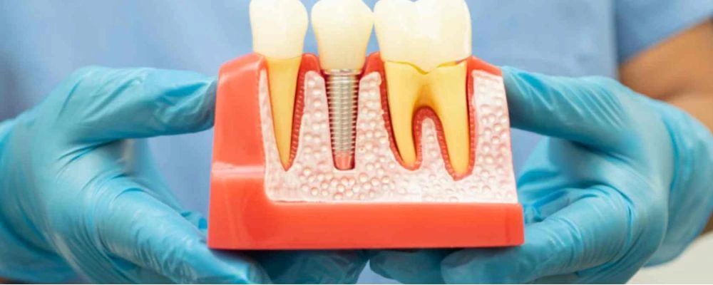 Dental Implants  and Implant supported dentures Image